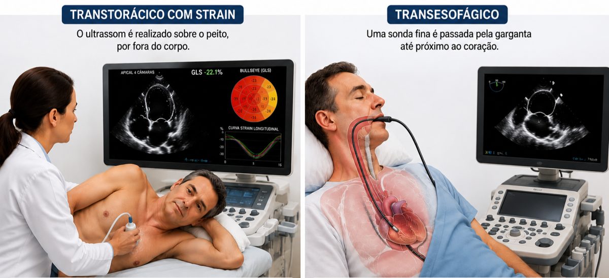 Tipos de ecocardiograma: transtorácico (ultrassom sobre o peito, por fora) e transesofágico (sonda fina pela garganta até perto do coração)